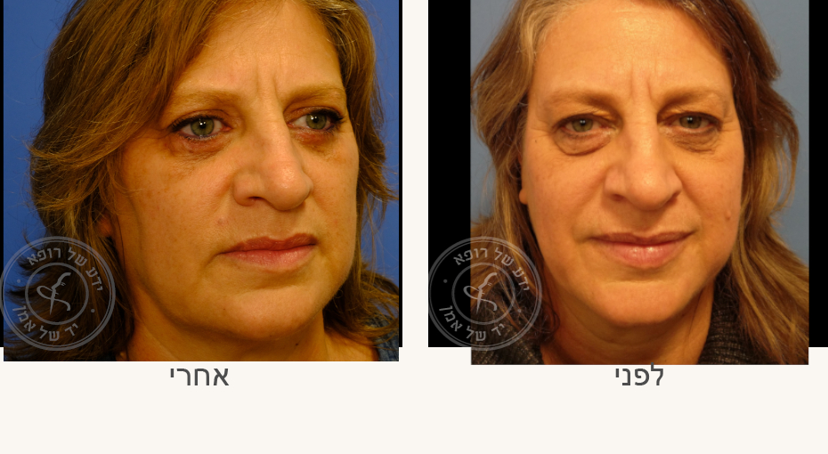 תמונת השוואה של עין אדם לפני ואחרי טיפול מוצלח להסרת קסנתלסמה.